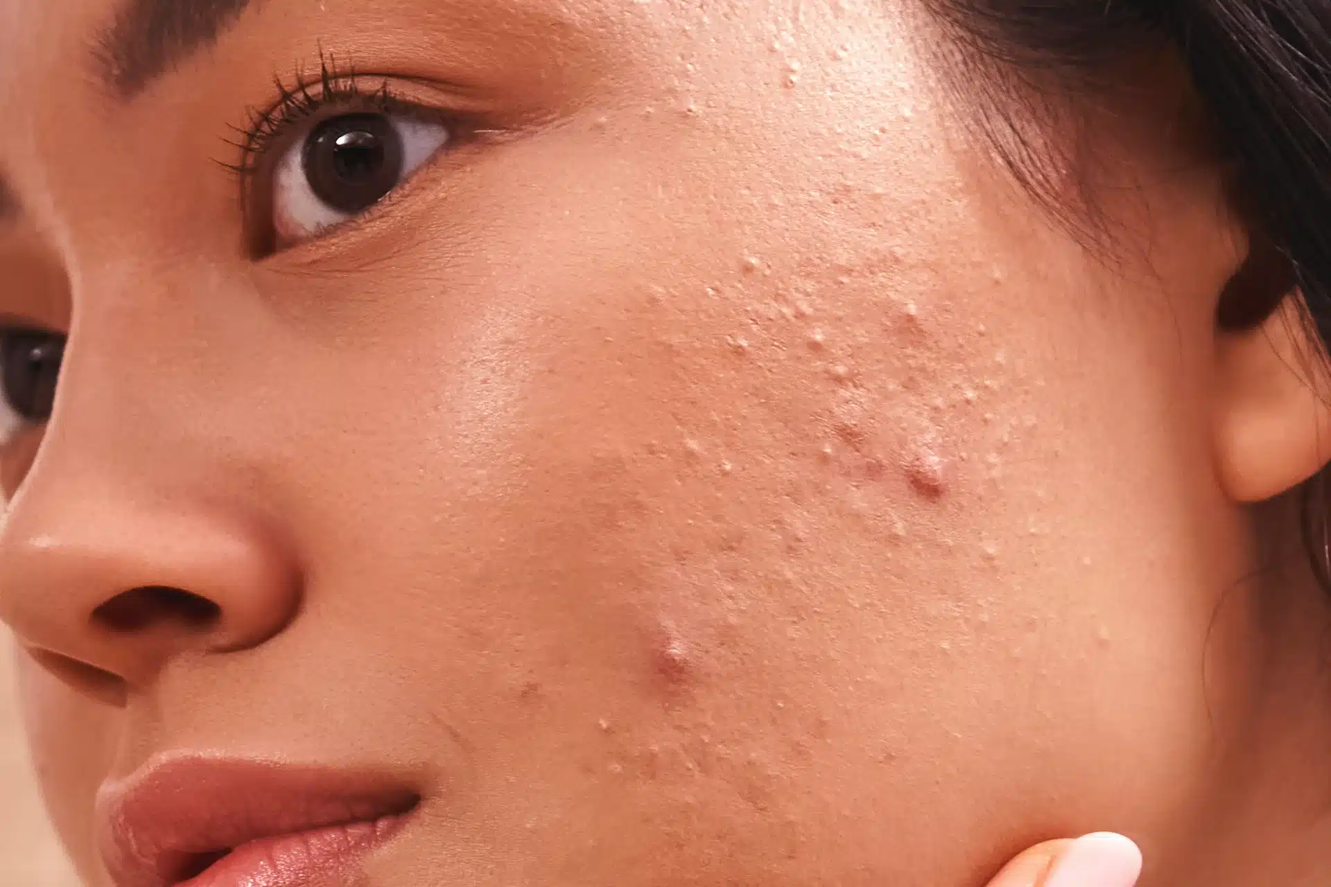 Acne scar image 01