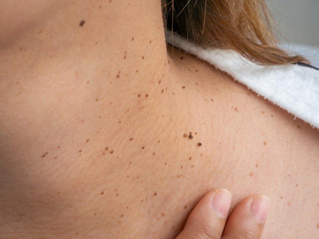 Warts on the neck