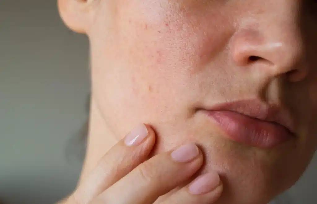 Close-up of facial skin showing enlarged pores and uneven texture