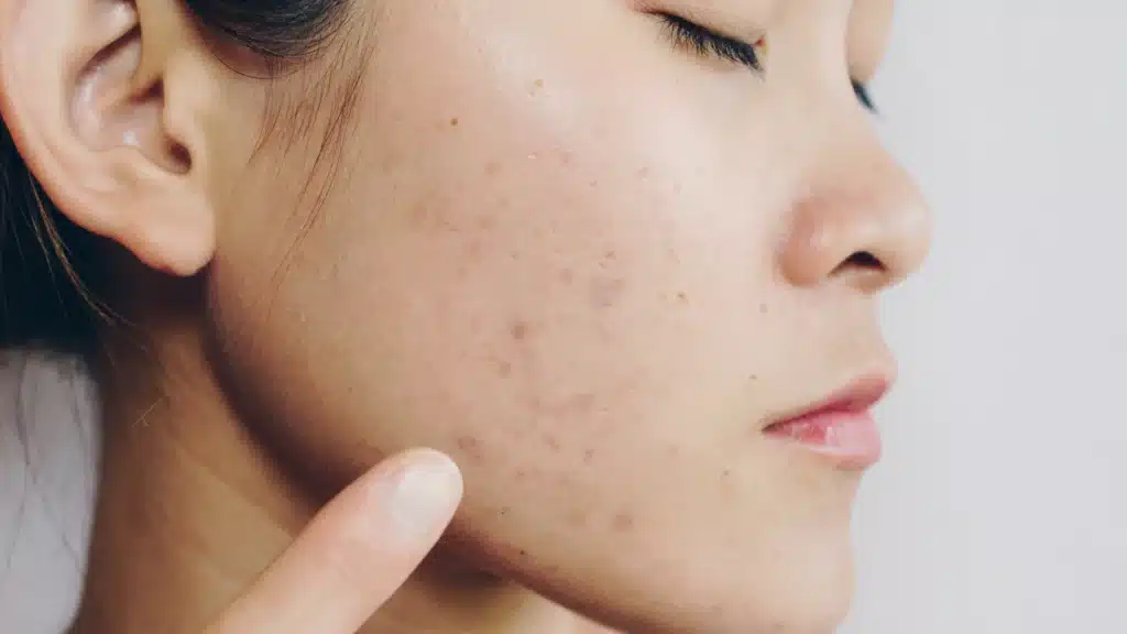 Close-up of a woman’s face with acne scars.