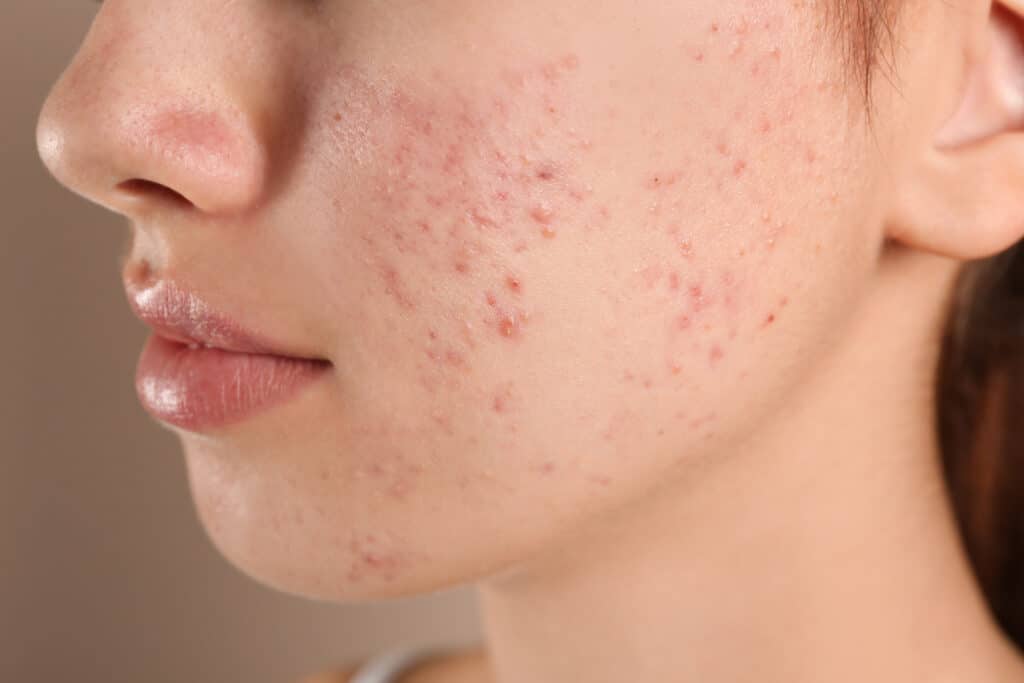 Teenage girl with acne problem