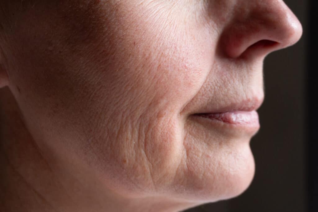 Close-up of facial skin texture and fine lines before HIFU treatment for skin tightening