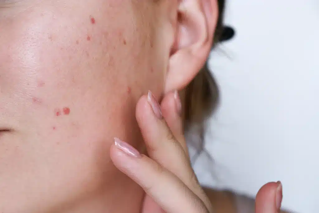 Close-up of a woman's face with acne scars