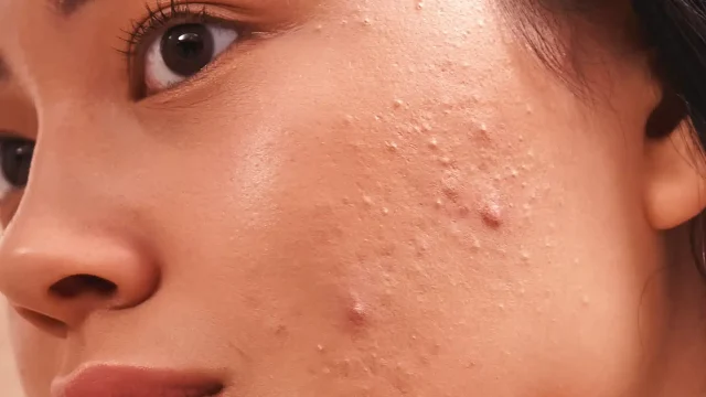 Acne scar image 01
