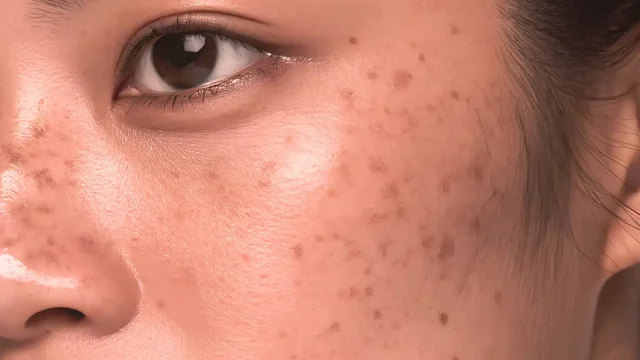 Pigmentation image